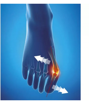 Epitact Hallux Valgus Oignon Orthèse Corrective de Nuit