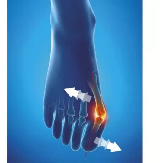 Epitact Hallux Valgus Oignon Orthèse Corrective de Nuit - image 3