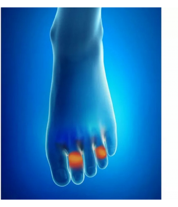 Epitact Protège-Pointes Orteils en Marteau ou en Griffe