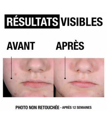 Neutrogena Anti-Bouton+ Gel Hydratant 50 ml - image 3