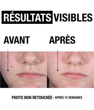 Neutrogena A/Bouton+ Gel Serum 30 ml