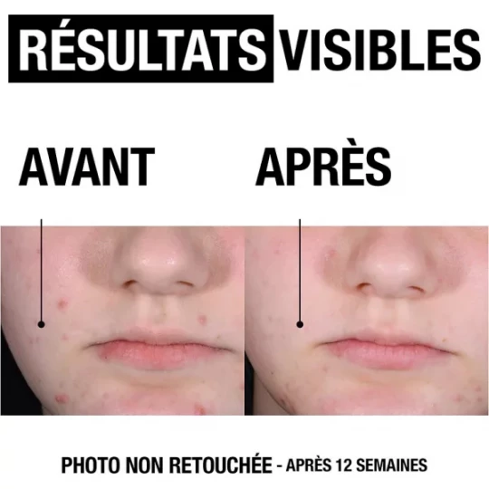 Neutrogena A/Bouton+ Gel Serum 30 ml - image 2